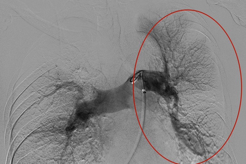 20240705 肺栓塞6_副本.jpg 20240705 肺栓塞6_副本.jpg