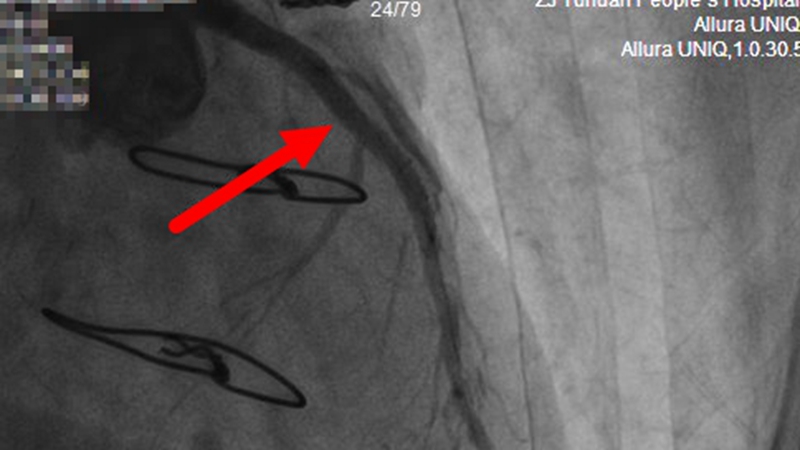 C:\Users\admin\Desktop\20230410心内科搭桥抢救\王熙平 冠脉手术截图 术后 前降支近段植入支架后 血管恢复正常直径.jpg