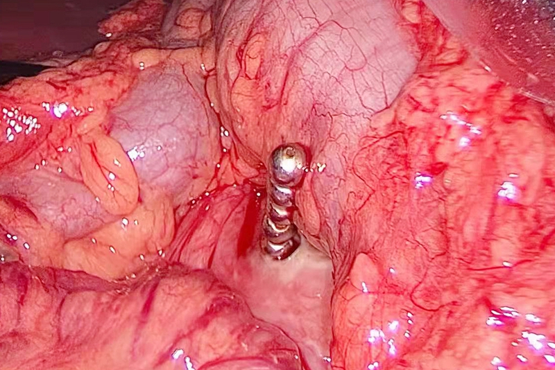 0412 误吞磁力珠3.jpg