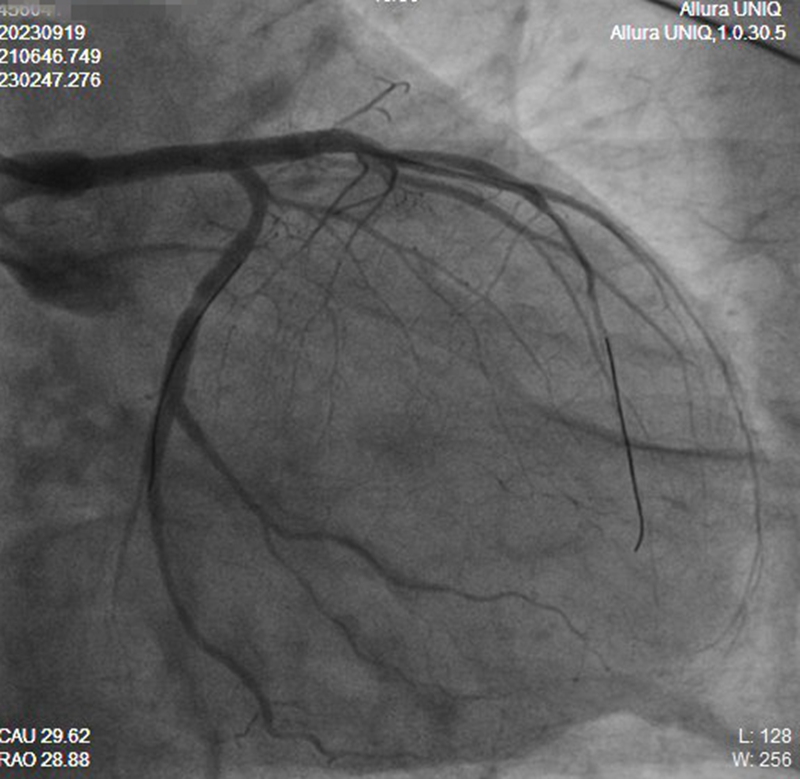 20230919 LM 101 术后.jpg