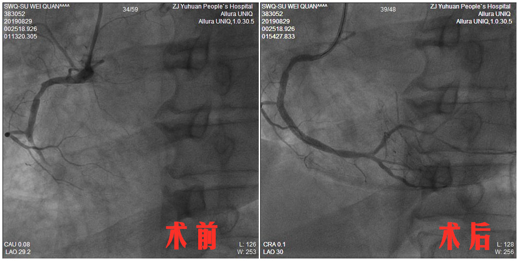 SWQ 右冠 术后_副本_副本.jpg