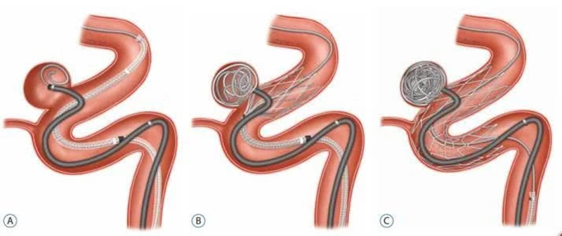 手术示意.jpg 手术示意.jpg