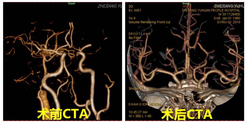 术后CTA_副本.jpg