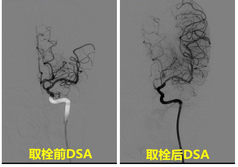 取栓DSA_副本.jpg