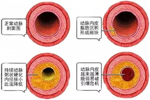 动脉硬化.png