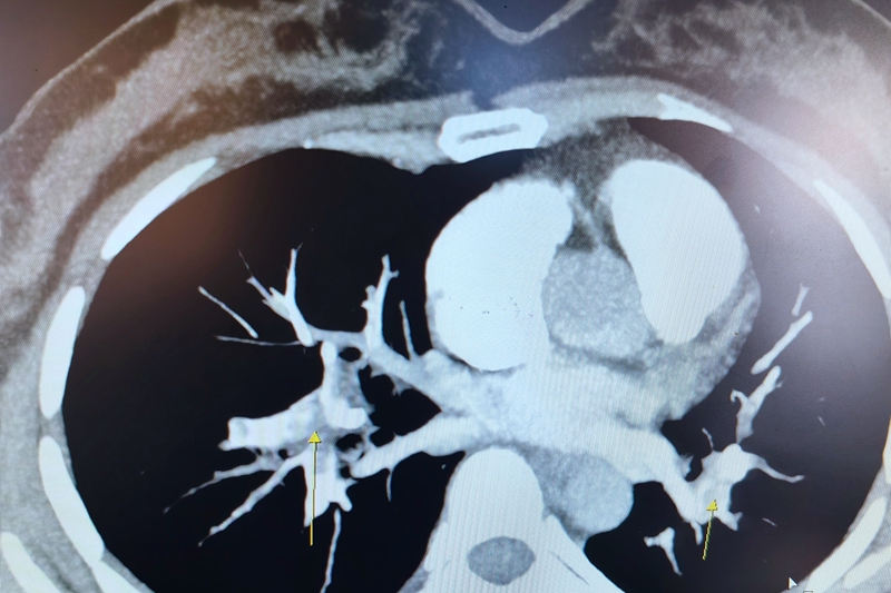 20250217 呼吸科 肺栓塞5.jpg