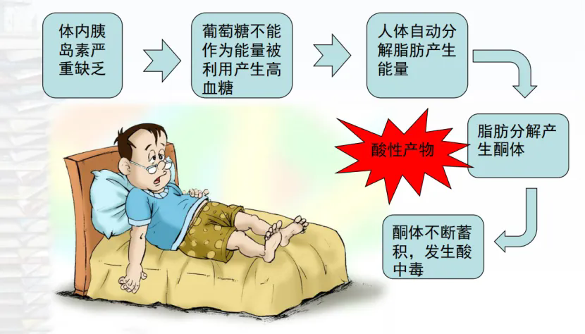 酮症原理.png 酮症原理.png